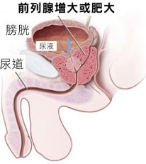 如何正确治疗前列腺肥大