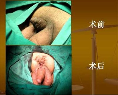 阴茎延长