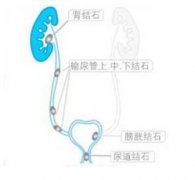 尿道结石的症状是什么