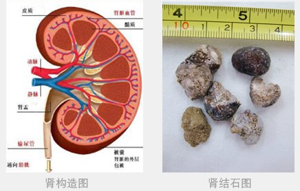 得了肾结石的症状是什么