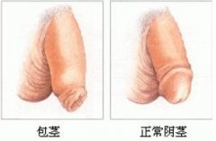 包茎有哪些类型