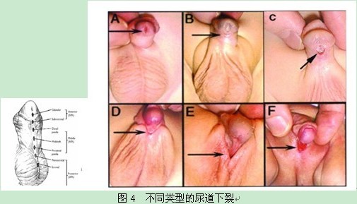 尿道下裂的危害