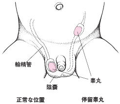专家解析如何正确诊断隐睾
