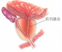 前列腺炎的图片