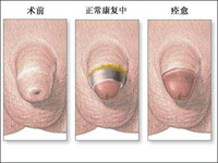 包皮过长手术前后对比图片