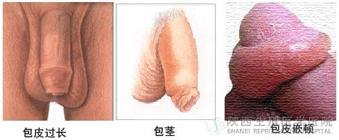 包皮过长一定要手术吗