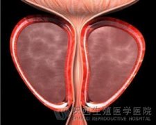 全面概述前列腺钙化是怎么回事