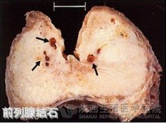 前列腺结石的原因是什么