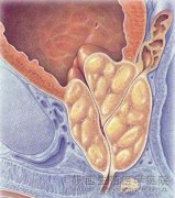前列腺囊肿的原因是什么