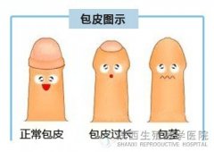 包皮手术后多久可以同房