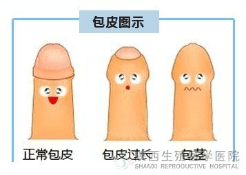 包皮手术后多久可以同房