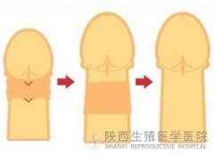 哪些人适合做阴茎增粗术