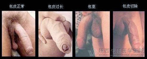 男性做包皮手术有什么好处