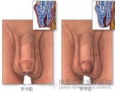 解决包皮过长 学生学习更专心